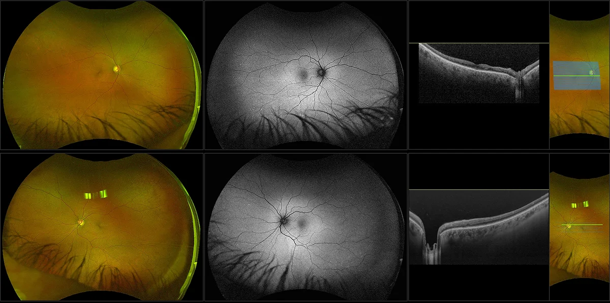 Silverstone - Proliferative Diabetic Retinopathy, RG, AF, OCT