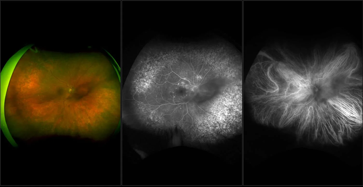 California - Age-Related Macular Degeneration (AMD), Peripheral Drusen, Media Opacity RG, FA, ICG