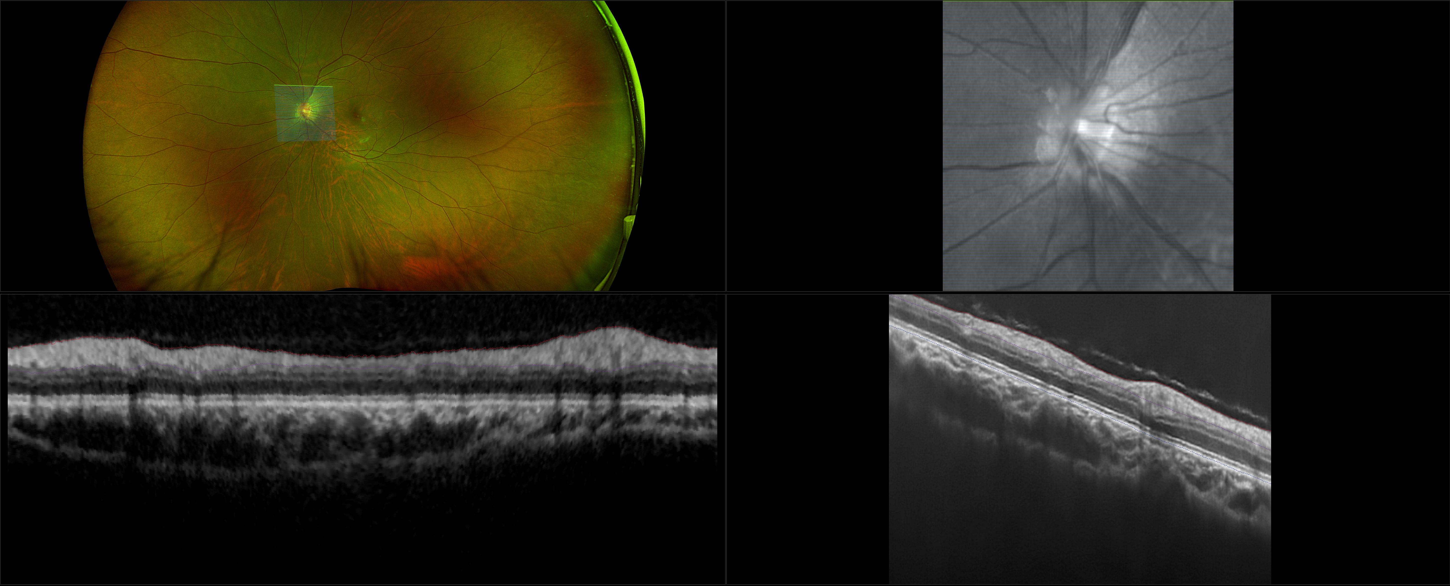 MonacoPro - Myopia - RG, OCT